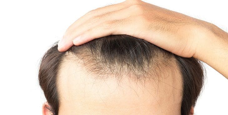 تكلفة زراعة الشعر في السعودية