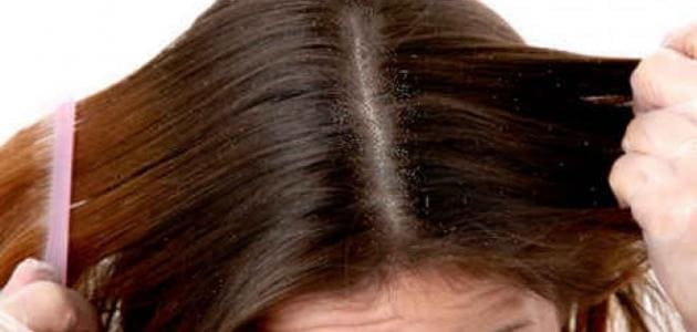 علاج حكة فروة الراس وتساقط الشعر