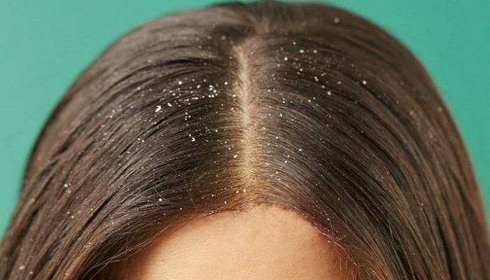 طرق علاج قشرة الشعر